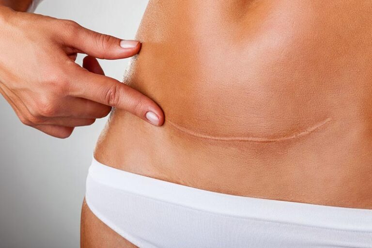 Ameliyat Skarı Mezoterapisi