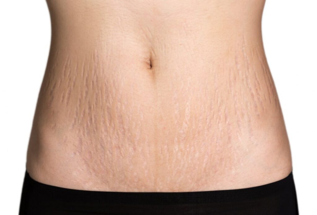 Stretch Mark Treatment