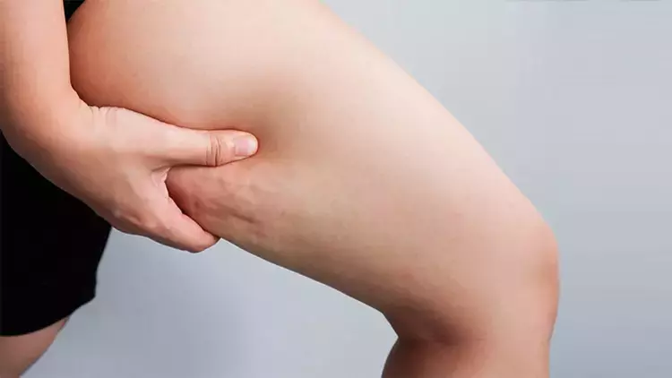 Bacak içi lipoliz Bacak içi lipoliz